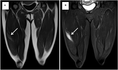 Skeletal Muscle Metastasis From Renal Cell Carcinoma: A Case Series and Literature Review